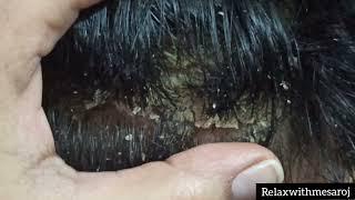 BIG DANDRUFF FLAKES !! Scalp Scratching and Satisfying Dandruff Removal !