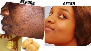 Remove Dark Spots In 10 Days with Potato Cream  | How To Get Rid Of Pimples and Acne