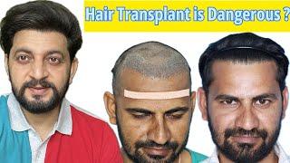 Natural looking Hair Transplant results | Hair Transplant Cost In India| Interlocking FUE technique