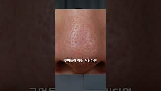 점점 더 피부에 구멍이 넓어지고 늘어난다면? #모공