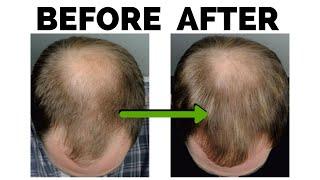 Growcomb For Hair Loss RESULTS! ETG Technology is HERE!