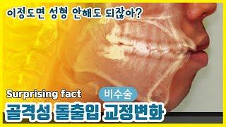 남자 돌출입치아교정 전후 후기 1분동안 보여드립니다.[발치교정, 치아교정 얼굴변화]