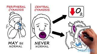 Hypoxia and Cyanosis: How to react when oxygen levels are low