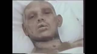 People affected by radiation during Chernobyl disaster. Radiation sickness. Part 1.