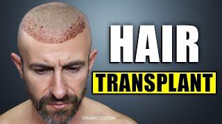 I Went to Bosley for a Hair Transplant