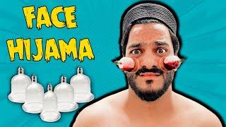 Face Hijama Karlia  | Kitna Pain hoa? | Mishkat Khan | Hijama Wet Cupping