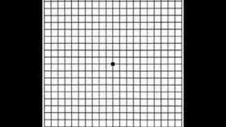 Grid for Macular Degeneration