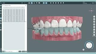 Adjusting a Treatment Plan | Digital Smile Design Software