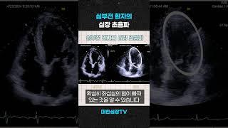 심실세동이 발생할 심장 상태