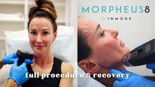 Morpheus 8  Radio-frequency + Microneedling Treatment Before & After! Full procedure & recovery