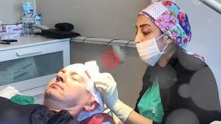 Transes Hair Transplant - FUE Hair transplant in Turkey