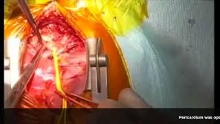 Cardiac surgery；CoA with VSD repair