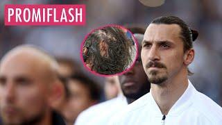 Zlatan Ibrahimovic hat eine krasse Verletzung am Hinterkopf