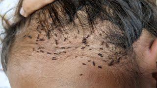 Wow there are thousand head lice - Remove thousand lice from brown hair