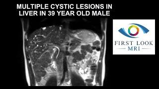 MULTIPLE CYSTIC LESIONS IN LIVER IN 39 YEAR OLD MALE