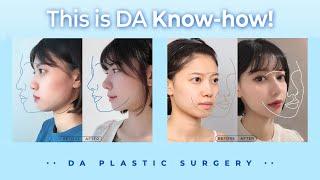 My Rhinoplasty, Facial Contouring and Eye Surgery at DA Plastic Surgery Korea!