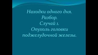 Находки одного дня. Случай 1. Опухоль головки поджелудочной железы.