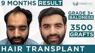 Best Hair Transplant Results in Delhi | Cost of Hair Transplant in Delhi