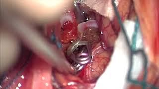 Clip reconstruction of left middle cerebral artery aneurysms