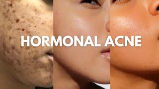 Treating Jawline Breakouts + Hormonal Acne | My Favorite Products Maskne | Black Girl Skin Care