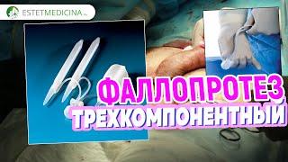 ТРЕХКОМПОНЕНТНЫЙ ФАЛЛОПРОТЕЗ. Как работает? Coloplast penile prosthesis Titan ЭРЕКТИЛЬНАЯ ДИСФУНКЦИЯ