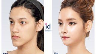 [ID Hospital Review]  Let Me In 4, Korea Plastic Surgery, ศัลยกรรมเกาหลี, ศัลยกรรมเกาหลีของคนไทย