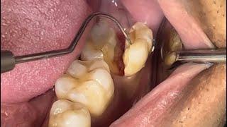 What happens if you don't get a crown after a root canal?