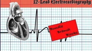 Bundle Branch Blocks - Part 1