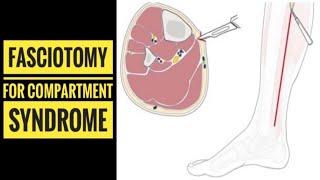 Fasciotomy for Leg Compartment Syndrome