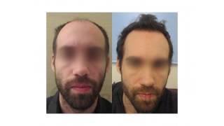 Advanced FUE Hair Transplant - Dr. Anastasios Vekris (30sec)