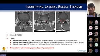 Neurogenic Claudication / Lateral Recess Stenosis : Ryan Khanna, MD