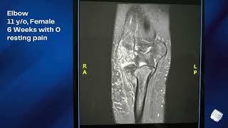 Subchondral Solutions - S-Core® - Riedel - Elbow - Aug 2024