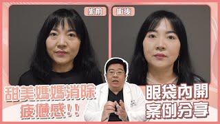 林敬鈞醫師分享眼袋內開案例 - 複合式眼袋內開, 讓甜美媽媽消除疲憊感!