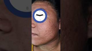 ACNE SCAR treatment #co2laser #laser #skin #beauty #shorts #skincare #health #aesthetic #acnescars