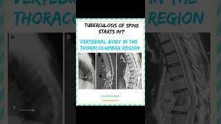 TUBERCULOSIS OF SPINE Follow @thephysiooworld9274 for more #physiotherapy #physio #bpt