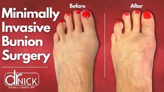 Minimally Invasive Surgery for Bunions | Dr. Nick