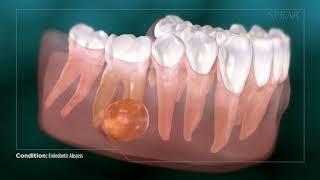 Dental Abcess - Why Root Canal Treatment Is Needed