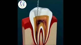 Root Canal Treatment Step by Step Animation