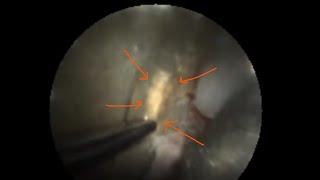 Calculus removal using Oravu Fiberscope