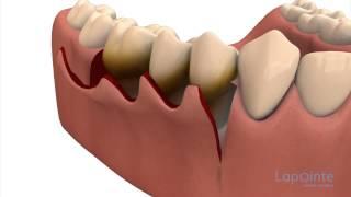 Periodontal flap approach surgery - Lapointe dental centres