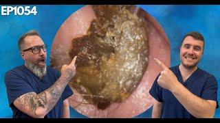 Removing Massive Ear Wax Blockages - EP1054