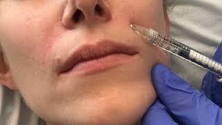 Juvéderm® Nasolabial Folds Demonstration