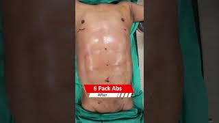 6 Pack Abs surgery | Six Pack Abs surgery Result | Liposuction cost #shortvideo #shots