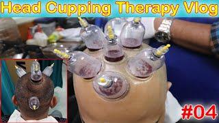 Hijama Cupping Therapy In Delhi | Best Treatment For Hair Loss And Regrowth