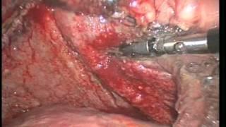 Dog Pericardiectomy (Heart Tumor) Minimally Invasive Surgery, Dr. Jeffrey Runge DAVCS