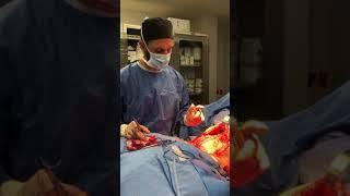 Tummy Tuck Diastasis Recti Repair During a Mommy Makeover Surgery