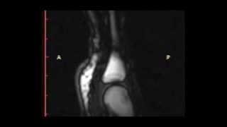 Real-Time Visualization of Joint Cavitation