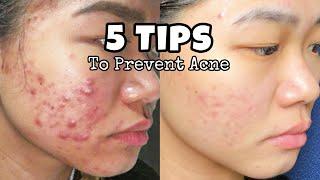 5 THINGS TO DO TO PREVENT ACNE