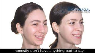 Jaw surgery Case # 108: Leanne - Maxillo-mandibular retrusion, lack of support of soft tissues