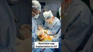 See hip replacement cup go in-THR in action #totalhipreplacement #jointreplacement #doctor